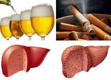 Người hút thuốc lá tăng nguy cơ gây ung thư gan.