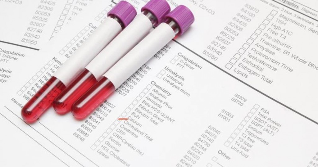 Men gan cao có thể phát hiện nhờ kết quả xét nghiệm máu