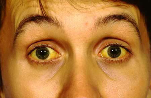 Vàng da, vàng mắt là biểu hiện của men gan cao, xơ gan
