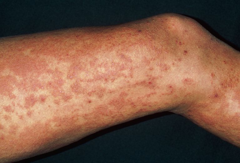 Xuất huyết dưới da là triệu chứng nguy hiểm của bệnh viêm gan B