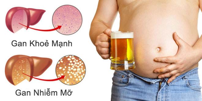 Rượu, bia là nguyên nhân chính khiến bệnh gan nhiễm mỡ độ 3 trở nên trầm trọng