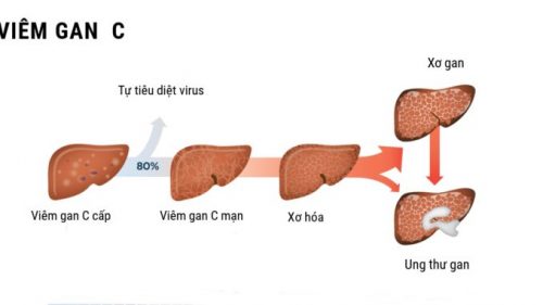 Viêm gan C có thể bị biến chứng thành xơ gan và ung thư gan