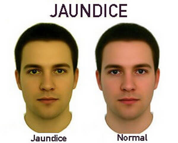 Sự khác biệt giữa vàng da (bên trái) và da bình thường