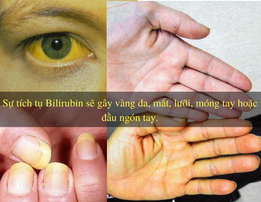 Vàng da là triệu chứng thường gặp của bệnh viêm gan