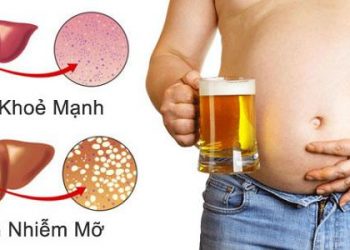 Gan nhiễm mỡ là gì? 6 điều bạn cần biết về căn bệnh nguy hiểm này