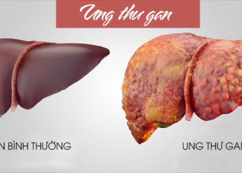 Ung thư gan là gì? 9 điều mà ai cũng cần phải biết trước khi quá muộn
