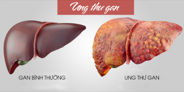 Ung thư gan là gì? 9 điều mà ai cũng cần phải biết trước khi quá muộn