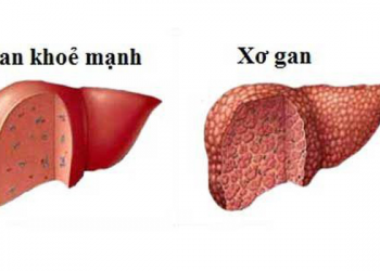 Xơ gan là bệnh gì? 13 Điều bạn cần biết về căn bệnh nguy hiểm này