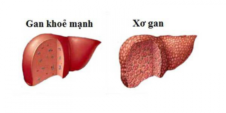 Xơ gan là bệnh gì? 13 Điều bạn cần biết về căn bệnh nguy hiểm này