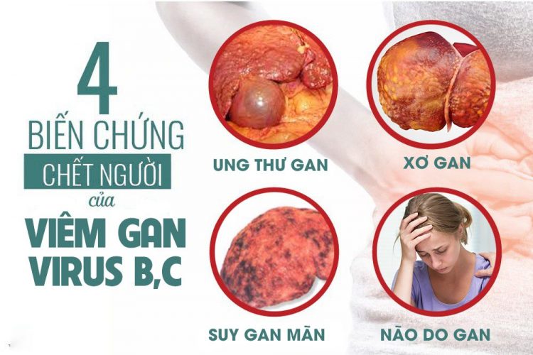 Tổng hợp các thông tin cần biết về căn bệnh Viêm Gan B