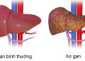 Xơ gan: Triệu chứng, nguyên nhân và cách điều trị