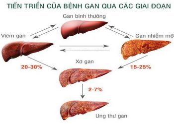 Xơ gan cổ trướng: Nguyên Nhân, Triệu Chứng và Cách Điều Trị