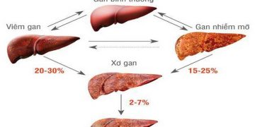 Xơ gan cổ trướng: Nguyên Nhân, Triệu Chứng và Cách Điều Trị