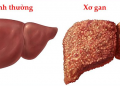 Xơ Gan – Nguyên nhân, biểu hiện, biến chứng và cách điều trị hiệu quả