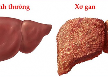 Xơ Gan – Nguyên nhân, biểu hiện, biến chứng và cách điều trị hiệu quả