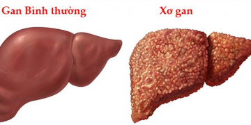 Xơ Gan – Nguyên nhân, biểu hiện, biến chứng và cách điều trị hiệu quả