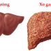 Xơ Gan – Nguyên nhân, biểu hiện, biến chứng và cách điều trị hiệu quả