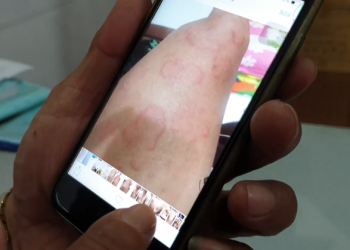 Nổi mề đay sần phù gần 2 năm ròng do bệnh gan, cải thiện chỉ sau 1 tháng