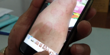 Nổi mề đay sần phù gần 2 năm ròng do bệnh gan, cải thiện chỉ sau 1 tháng