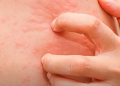 Thoát khỏi nỗi ám ảnh mẩn ngứa mề đay dai dẳng nhiều năm chỉ sau …3 tháng