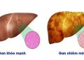 Chuyên gia gan mật chỉ ra những nguyên nhân triệu chứng điển hình và cách điều trị khoa học gan nhiễm mỡ