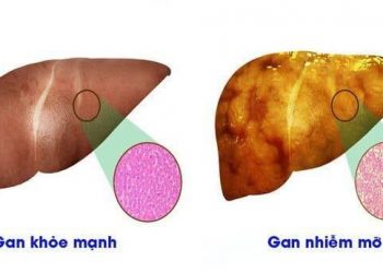 Chuyên gia gan mật chỉ ra những nguyên nhân triệu chứng điển hình và cách điều trị khoa học gan nhiễm mỡ