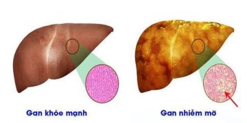Chuyên gia gan mật chỉ ra những nguyên nhân triệu chứng điển hình và cách điều trị khoa học gan nhiễm mỡ